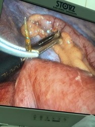 Phẫu thuật Nội soi thành công cho bệnh nhân viêm phúc mạc do dị vật xương cá đâm thủng ruột